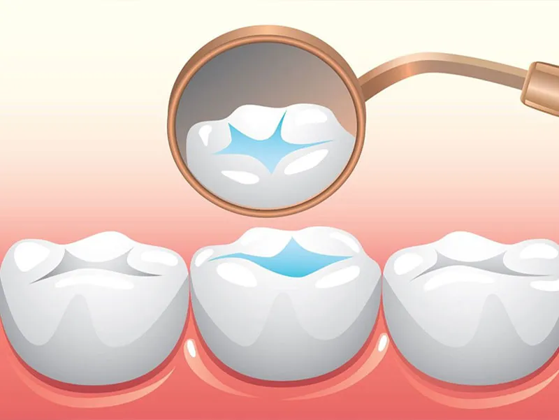 پوسیدگی و پیشگیری از آن