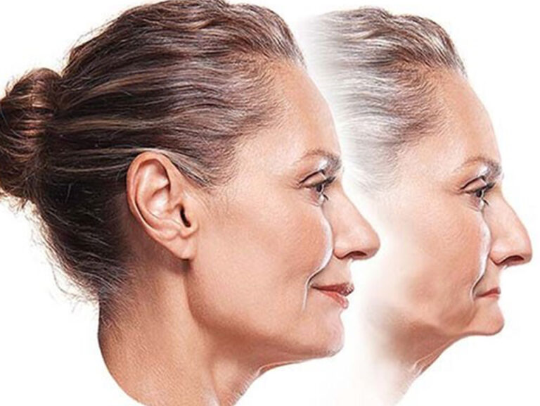 تاثیر اوردنچر بر جوان شدن چهره_دکتر میلاد محمدی